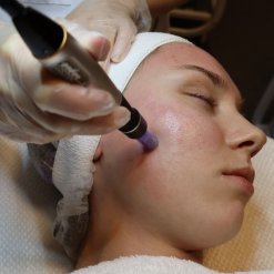 Microneedling Dermapen cure face hair neck back Stockholm bild11