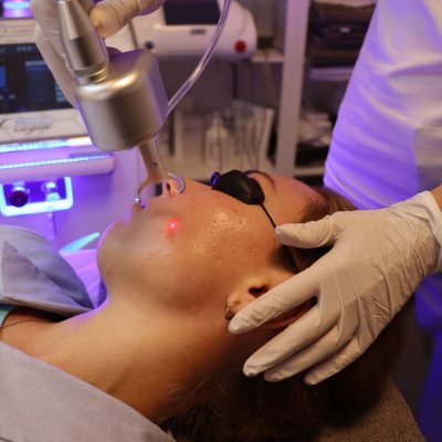 fractionated laser acne scar on the face stockholm bild14