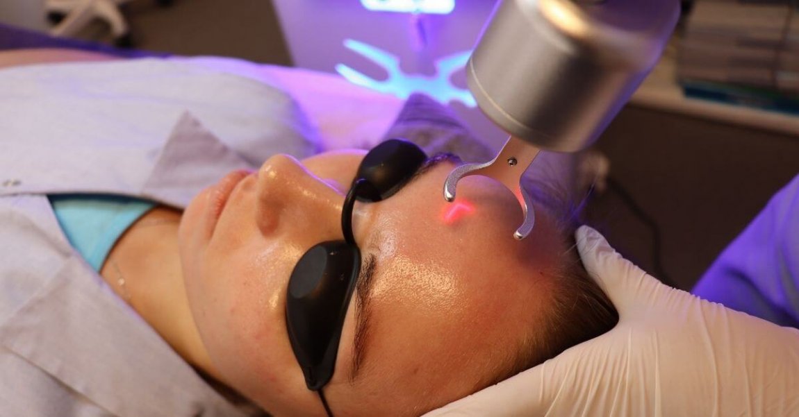 Fractionated laser against acne scars laser treatment bild21