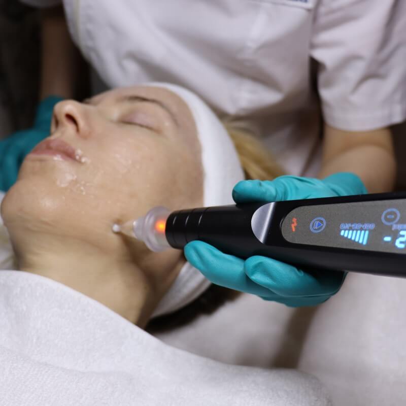 Effektiv Plasma lift behandling Stockholm Beautyka hudvårdsklinik