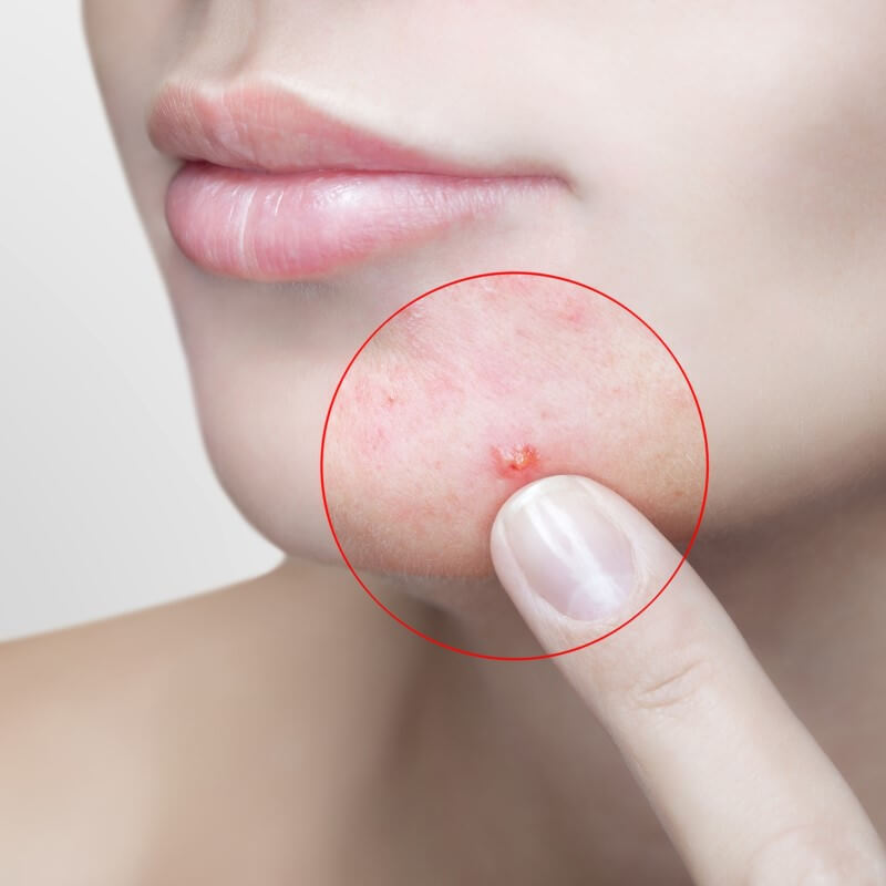 Kemisk peeling acneärr acne syrabehandling Stockholm Beautyka hudvårdsklinik