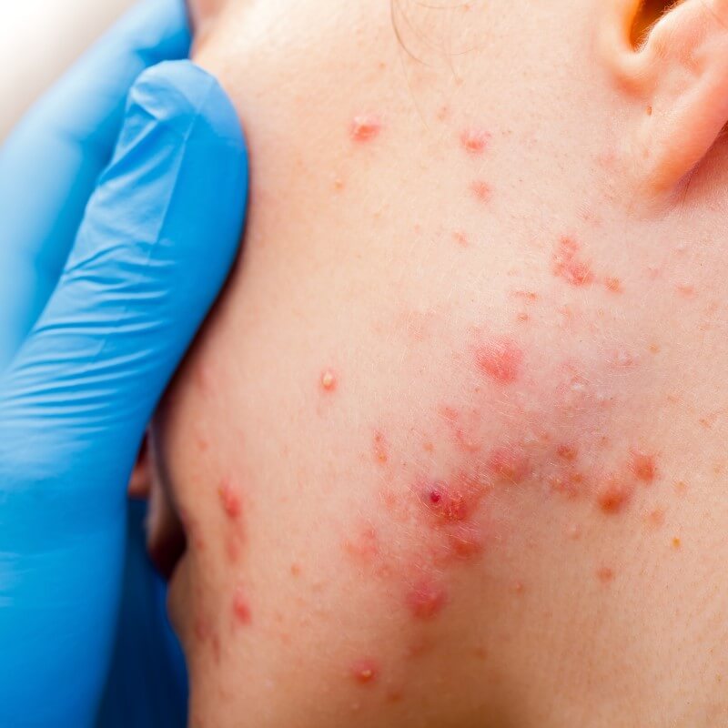 Syrabehandling acne med kemisk peeling Stockholm Beautyka hudvårdsklinik