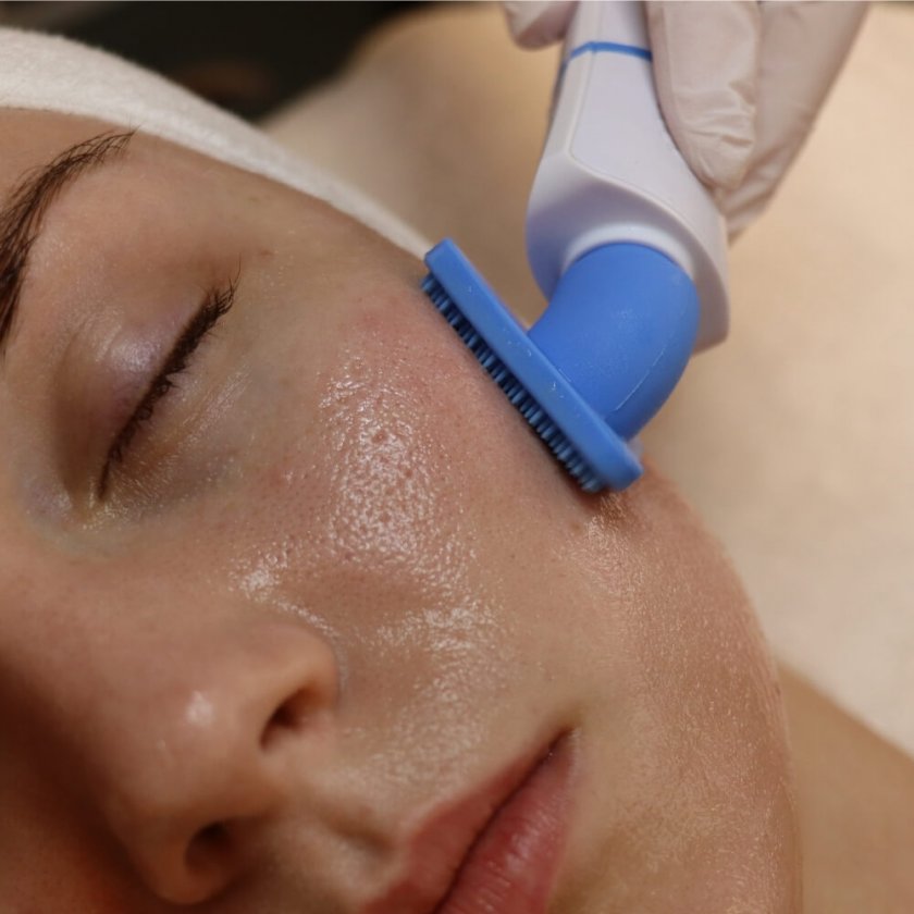 Porrengörande peeling med ultraljud erbjudande hudvårdsklinik Stockholm bild11