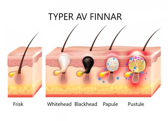 Types of pimples on problem skin image 1